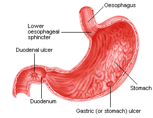 stomach ulcers and duodenal ulcers