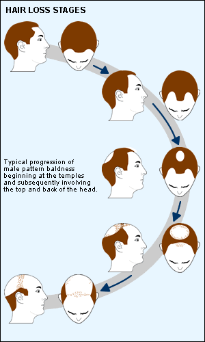 hair loss stages