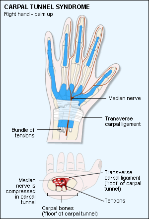 carpal tunnel