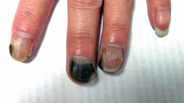 green nail syndrome