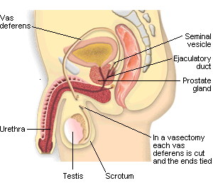 vasectomy