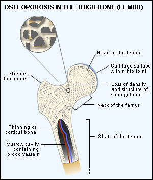 osteoporotic bone