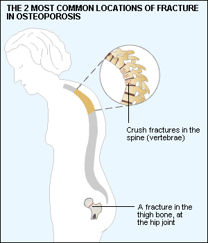 osteoporosis - 2 most common fractures