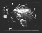 ultrasound of baby ultrasound of baby