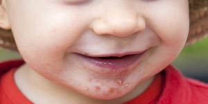 hand foot and mouth disease rash 