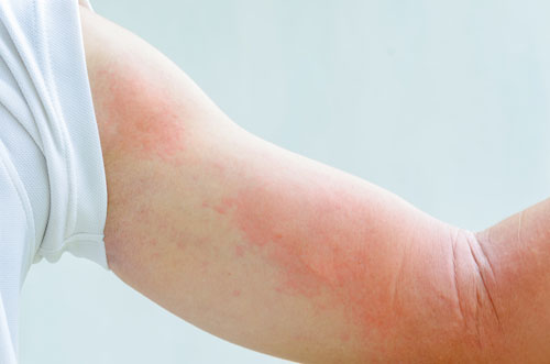 urticaria rash has red weals with skin-coloured centres and is usually very itchy