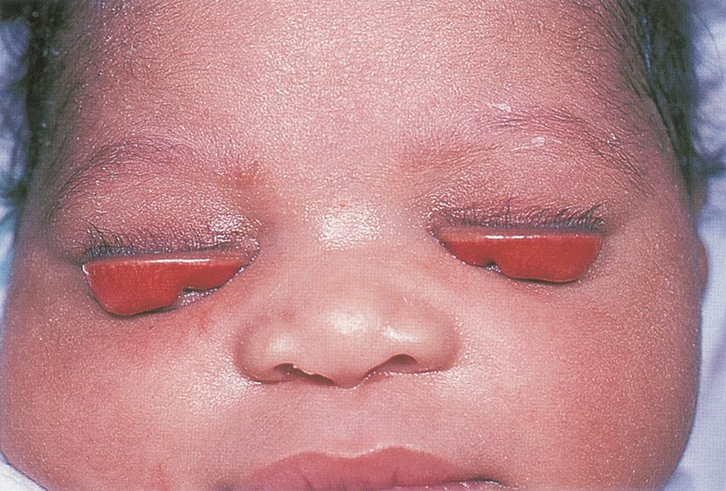Congenital Eyelid Eversion American Academy Of Ophthalmology