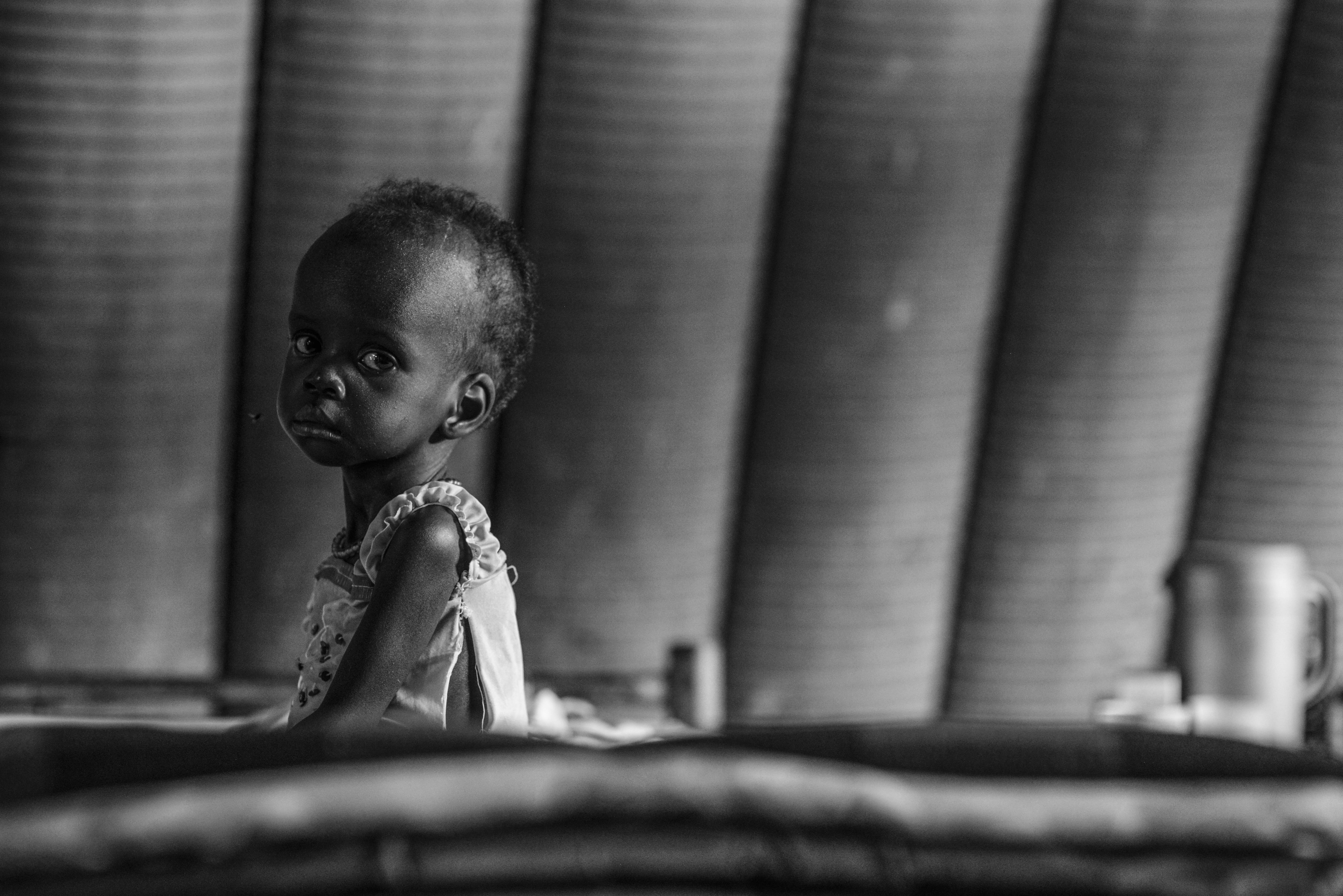 Nyakandai, 1, suffers from severe acute malnutrition in Juba, South Sudan. Such cases have increased due to the fighting in the country. Photo by Sebastian Rich for UNICEF