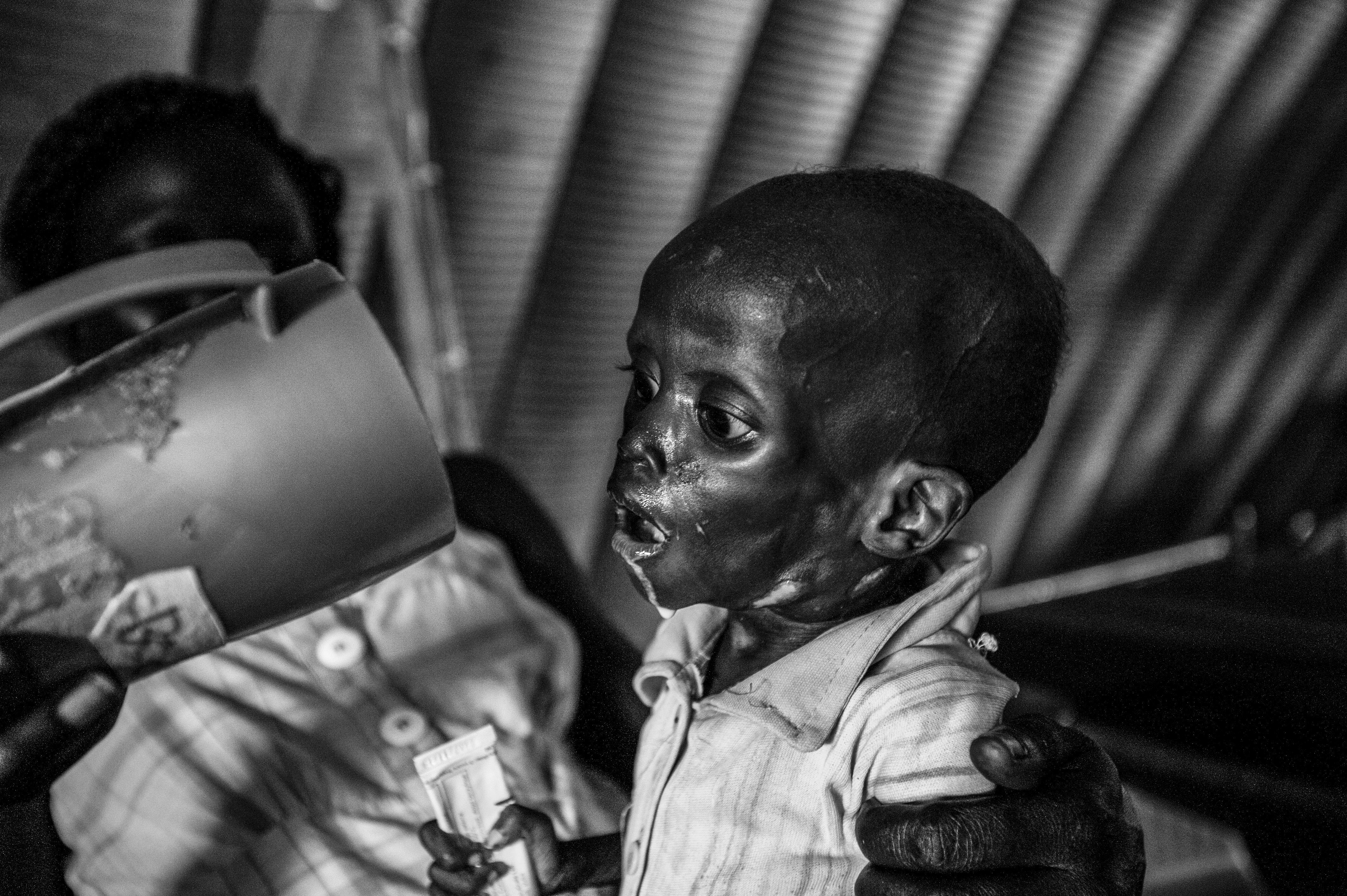 Jal Puok is one of the worst cases of severe acute malnutrition that doctors have seen. Photo by Sebastian Rich for UNICEF