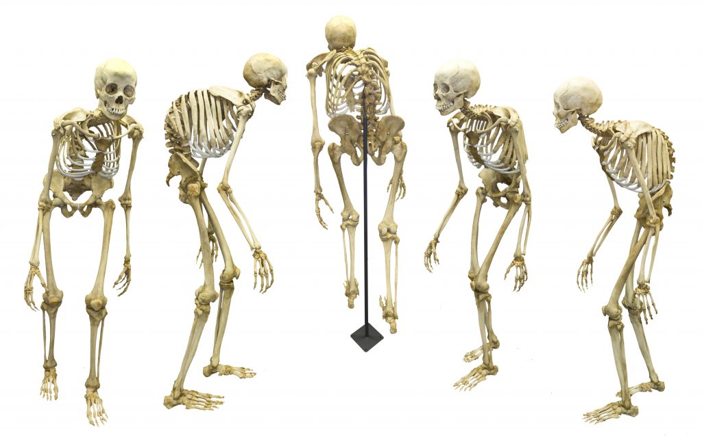 Skeleton of a person with kyphosis, cleaned, articulated and displayed by Skulls Unlimited. Courtesy of SkullsUnlimited.com.