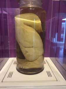 A wet specimen of a leg from the National Museum of Health and Medicine. Photo by Kristin Hugo.