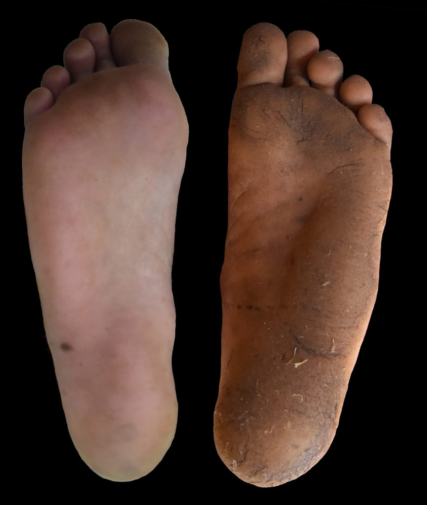 A comparison of the foot calluses of a person who usually wears shoes and a person who usually walks barefoot (right). Calluses are an adaptation to protect feet, but many people have replaced them with shoes. Image by Daniel Lieberman