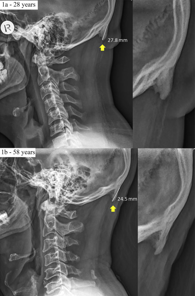 Example radiographs of two male participants (28-years-old and 58-years-old) presenting with large EOPs, according to the study. Image Shahar D. and Sayers M., Scientific Reports, 2019/CC BY 4.0