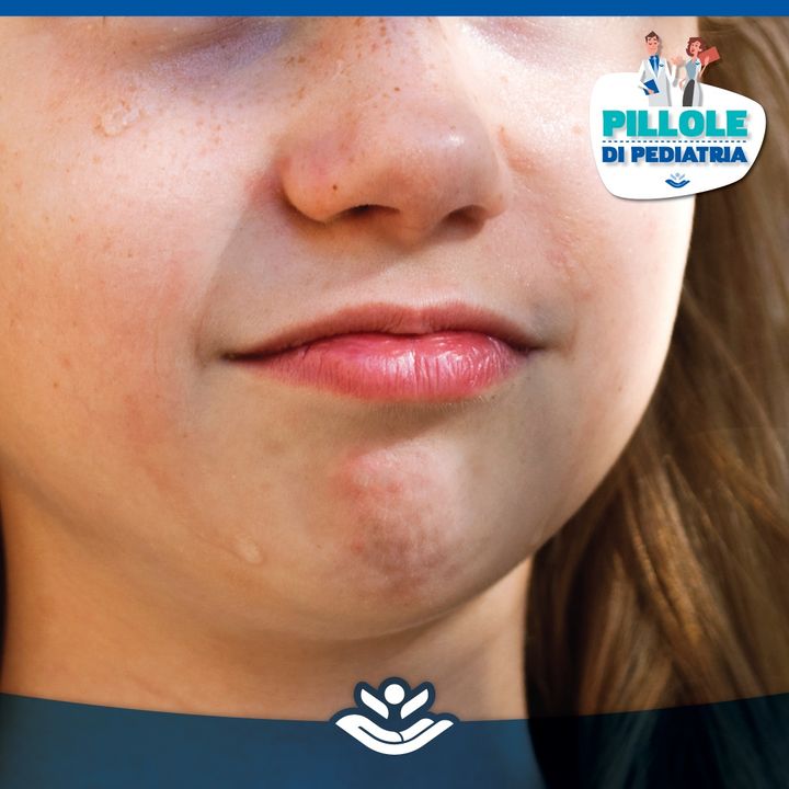 Macchie Cutanee O Macchie Della Pelle Nel Bambino Ospedale Pediatrico Bambino Gesu