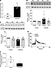 Increased RhoA/Rho kinase activity and blunted [Ca2+]i transients in CADASI