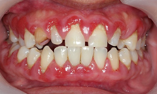 Severe Gum Disease May Be Early Sign Of Diabetes Rcni