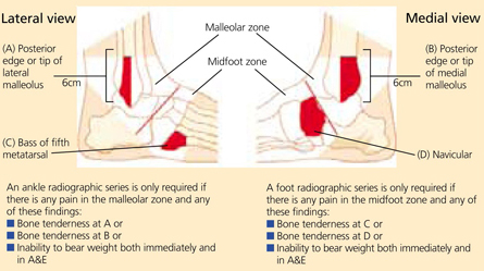 Assessment And Management Of Foot And Ankle Fractures