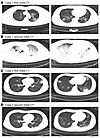 Computed tomography of the chest of patients with COVID-19.