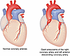 Coronary artery damage from KD.