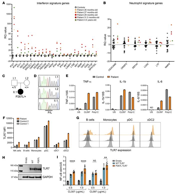 TLR7 gain-of-function mutation in a young child with severe SLE.
(A) Per...