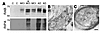 ΔTau becomes increasingly insoluble with disease progression and is associa