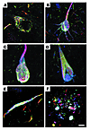 ΔTau is present throughout the evolution of NFT pathology. Triple immunoflu