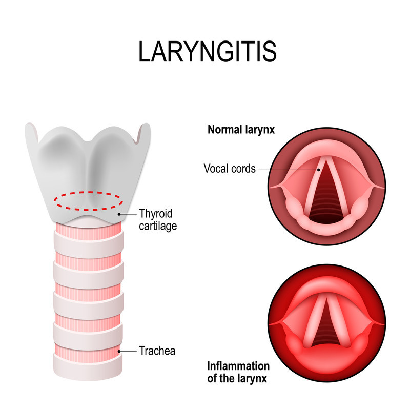Laryngitis Harvard Health