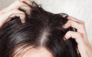 Ampuh! Cara Menghilangkan Kutu Rambut dengan Minyak Kayu Putih