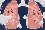 肺癌9大前兆：久咳不愈、胸痛、体重下降