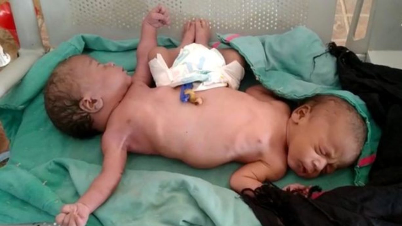 Gêmeas siamesas nascem com duas pernas e quatro braços e desafiam médicos