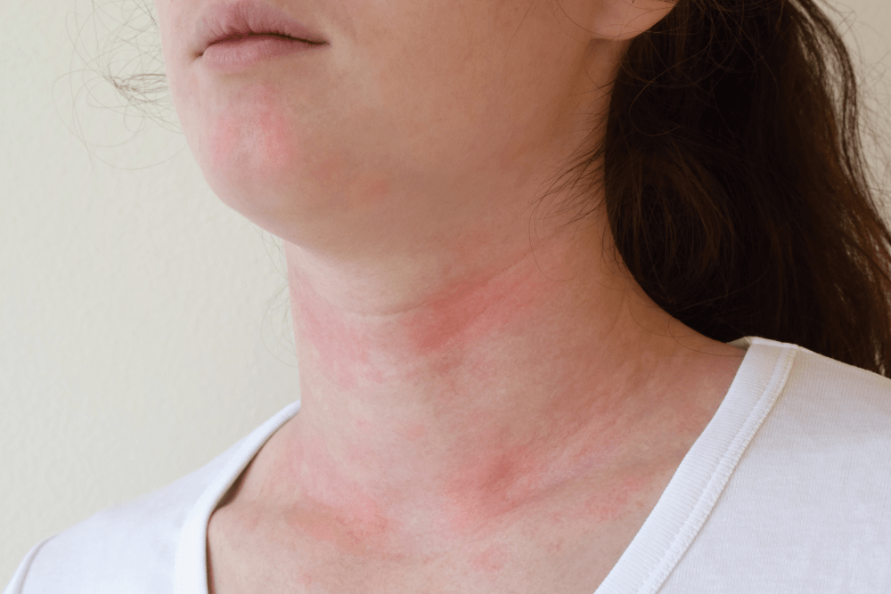 Alcohol Allergy Allergykb