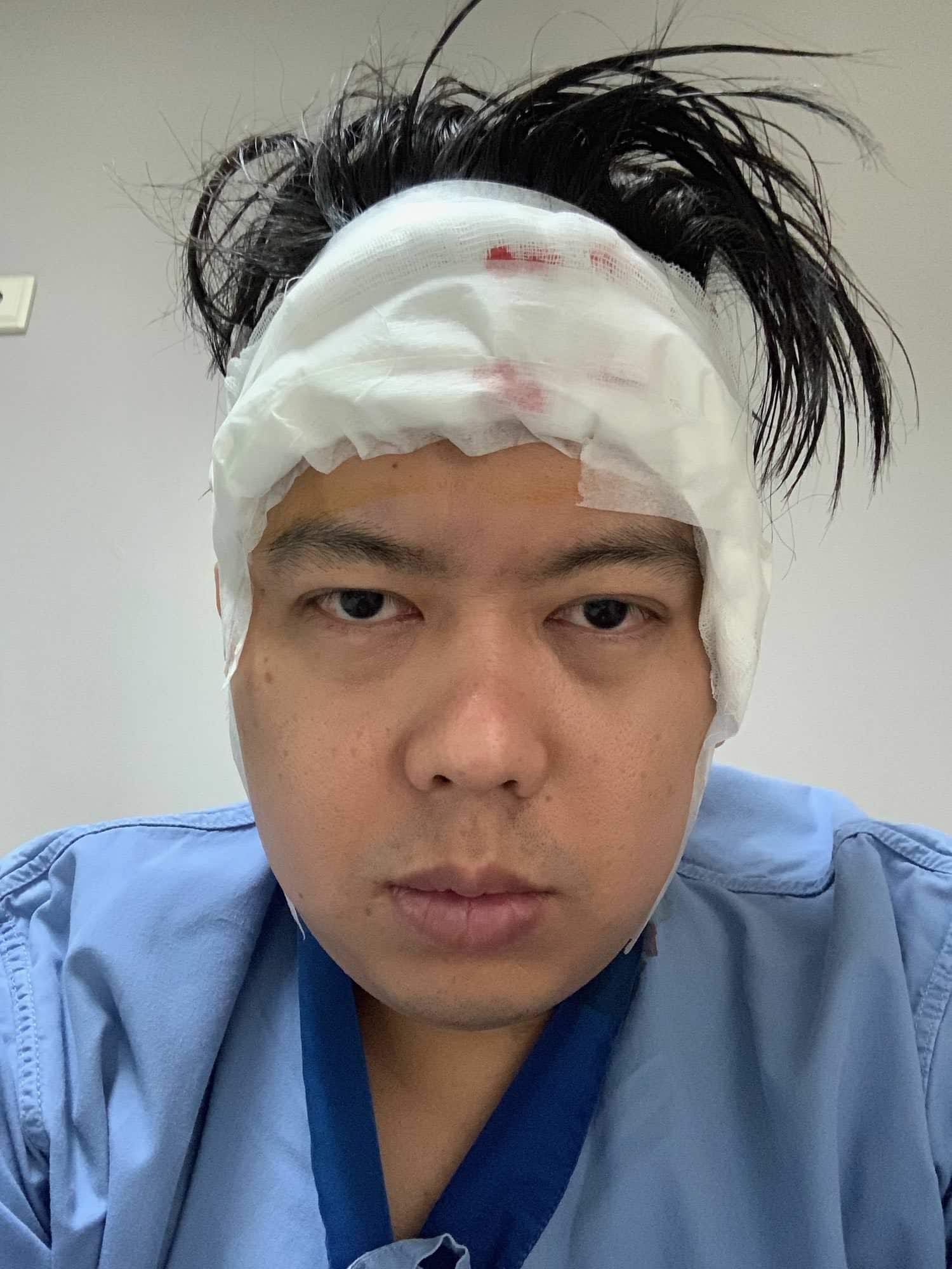 รีวิวการปลูกผม กับเรื่องราว ณ วันผ่าตัด 12 ปลูกผม - รีวิวการปลูกผม กับเรื่องราว ณ วันผ่าตัด