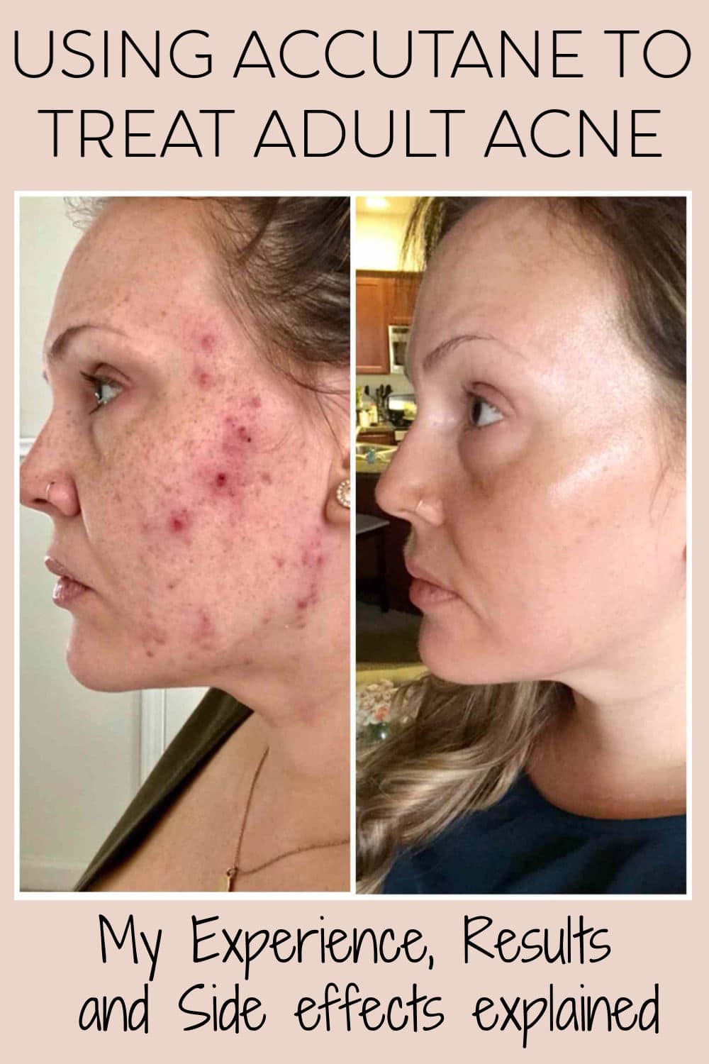 Accutane For Adult Acne My Experience