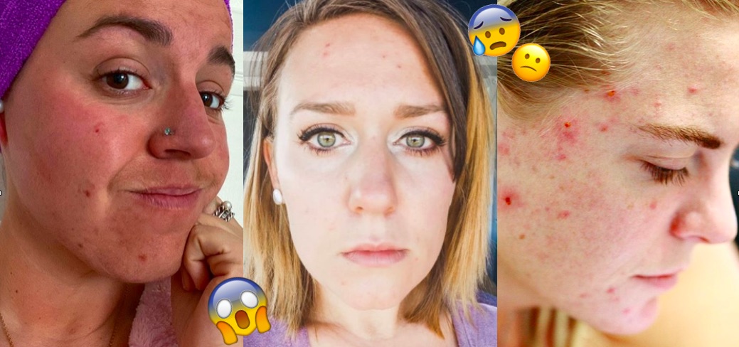 Acne Da Stress Le Cause I Migliori Rimedi E I Trattamenti