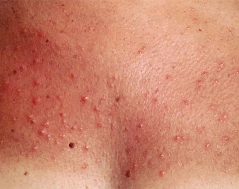 Dermatite Solare Cos E Come Prevenirla E Come Curarla