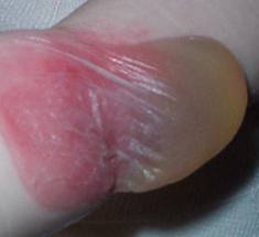 Blister 1