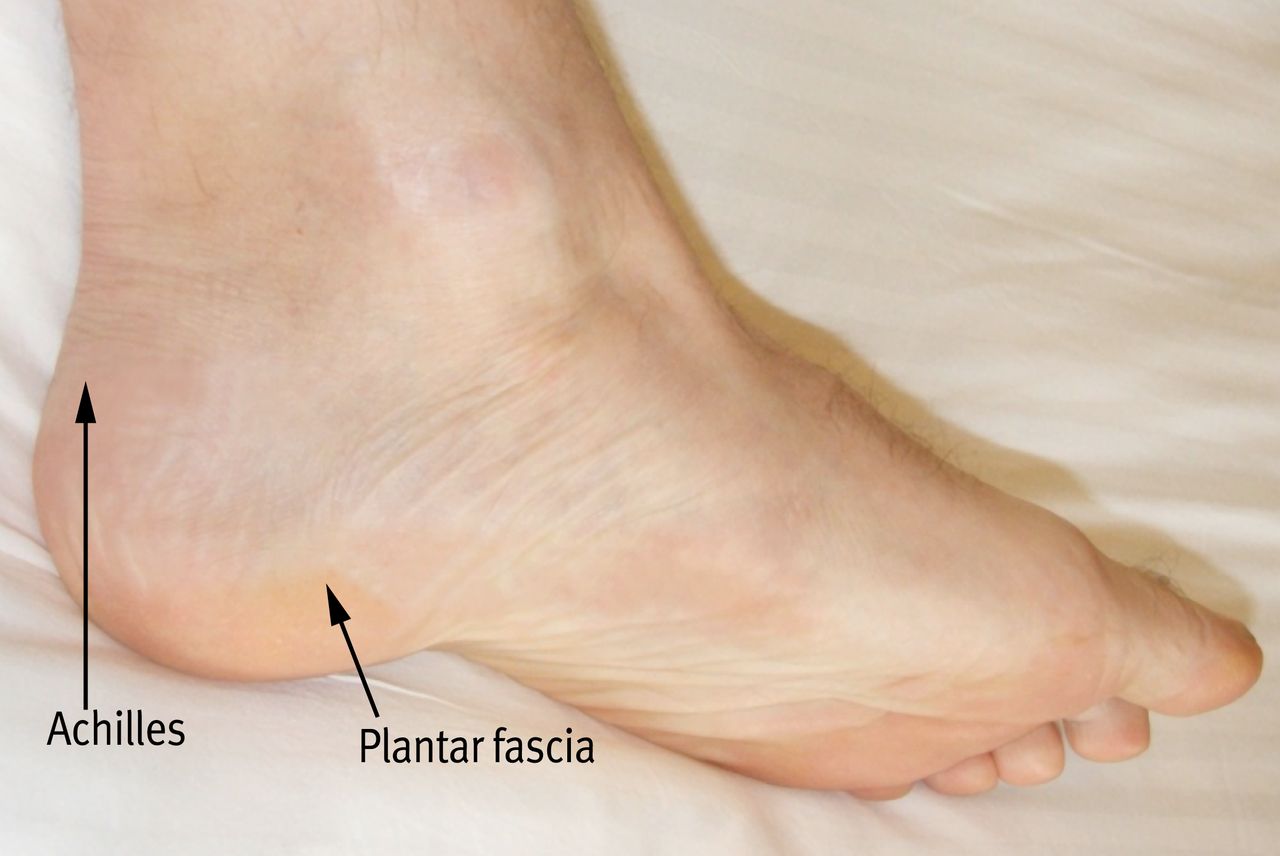 Figure 4: Surface anatomy showing comparative locations ('X') of Achilles heel pain & plantar fascia heel pain.