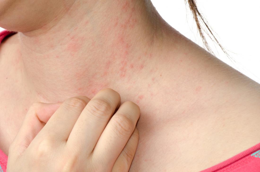 woman with eczema on the neck