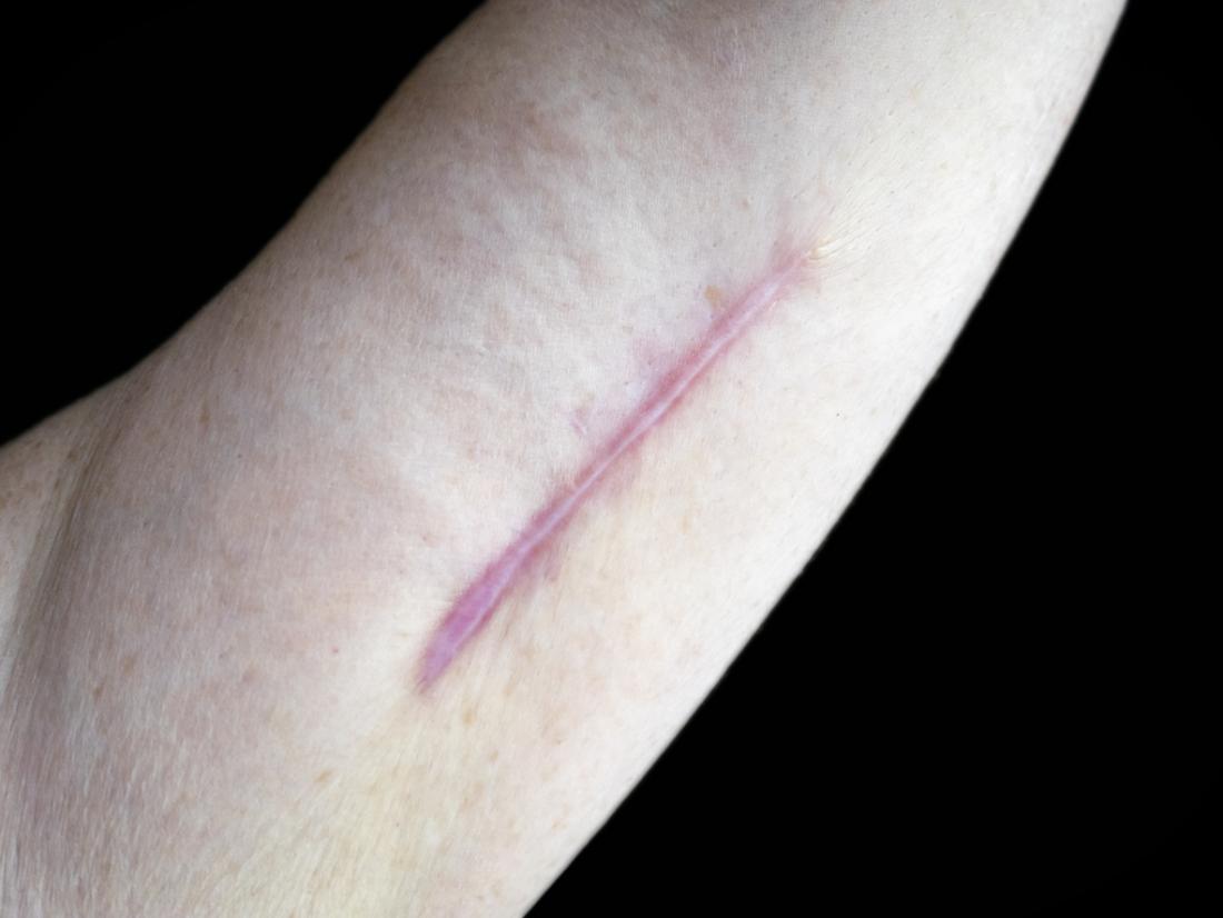 keloid scar on arm