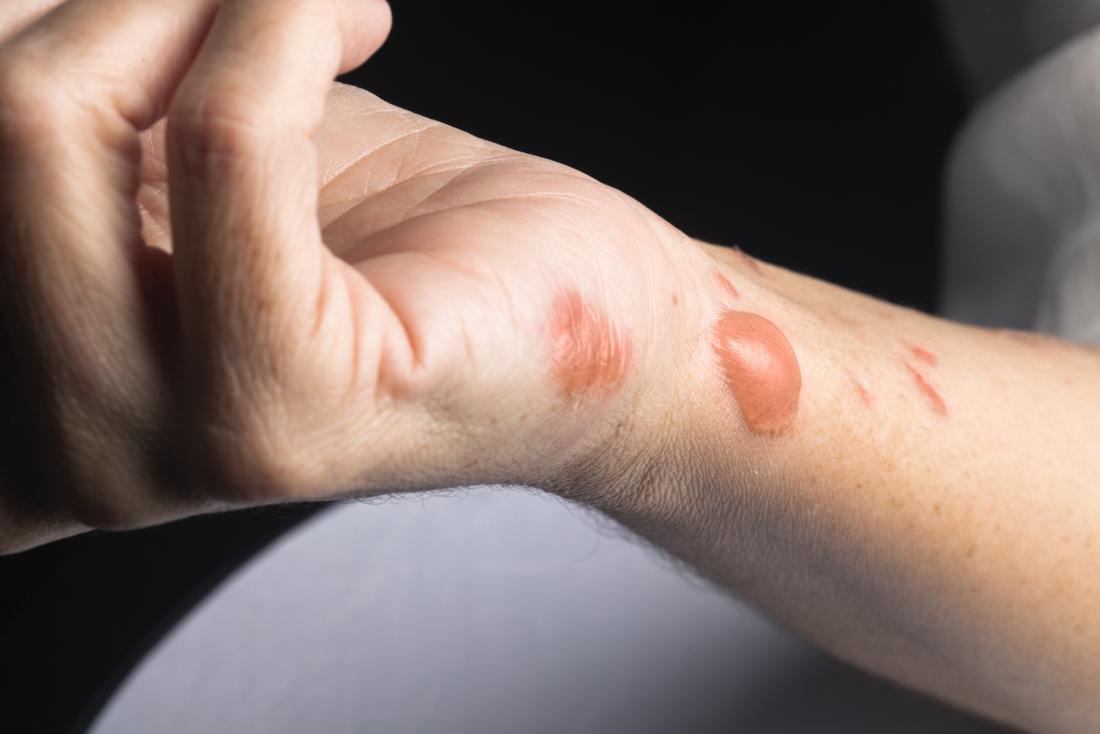 how to keep a burn from scarring