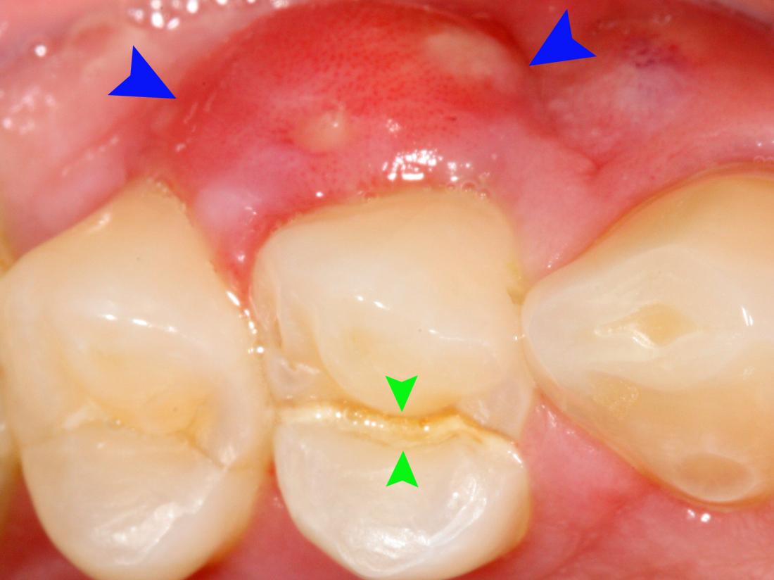 Gum Boils What They Are And How To Treat Them