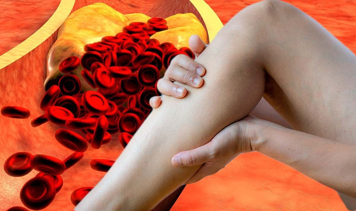 High Cholesterol Symptoms Include Sores On Your Legs Contact A Gp Ro Tv Online