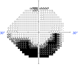 Champ Visuel Humphrey Et Goldmann Examen Ophtalmologique Rdv