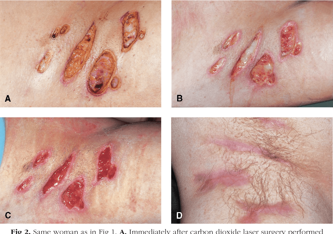 Carbon Dioxide Laser Treatment For Hidradenitis Suppurativa Otosection