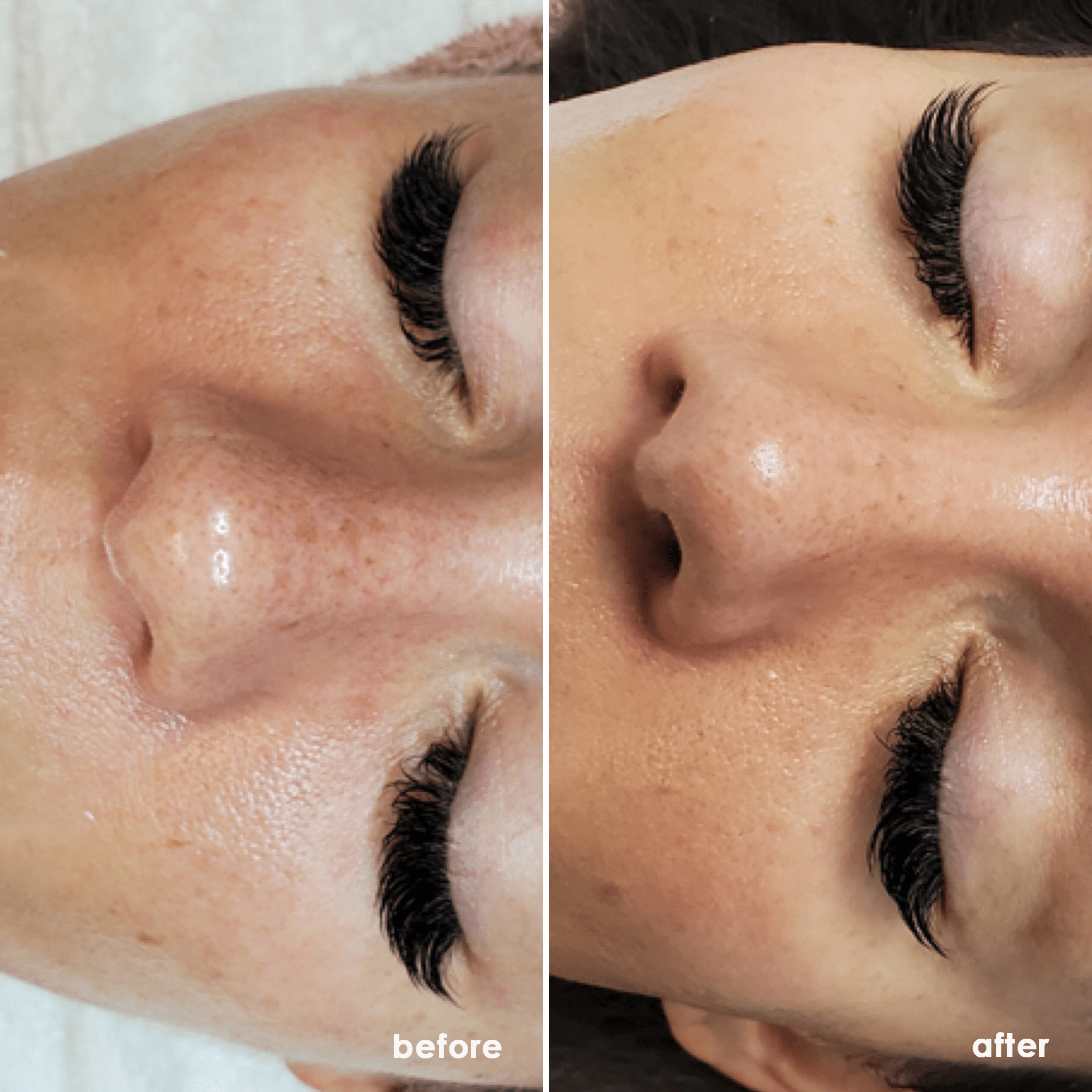 How Do I Prepare For My Dermaplaning Treatment Dermica