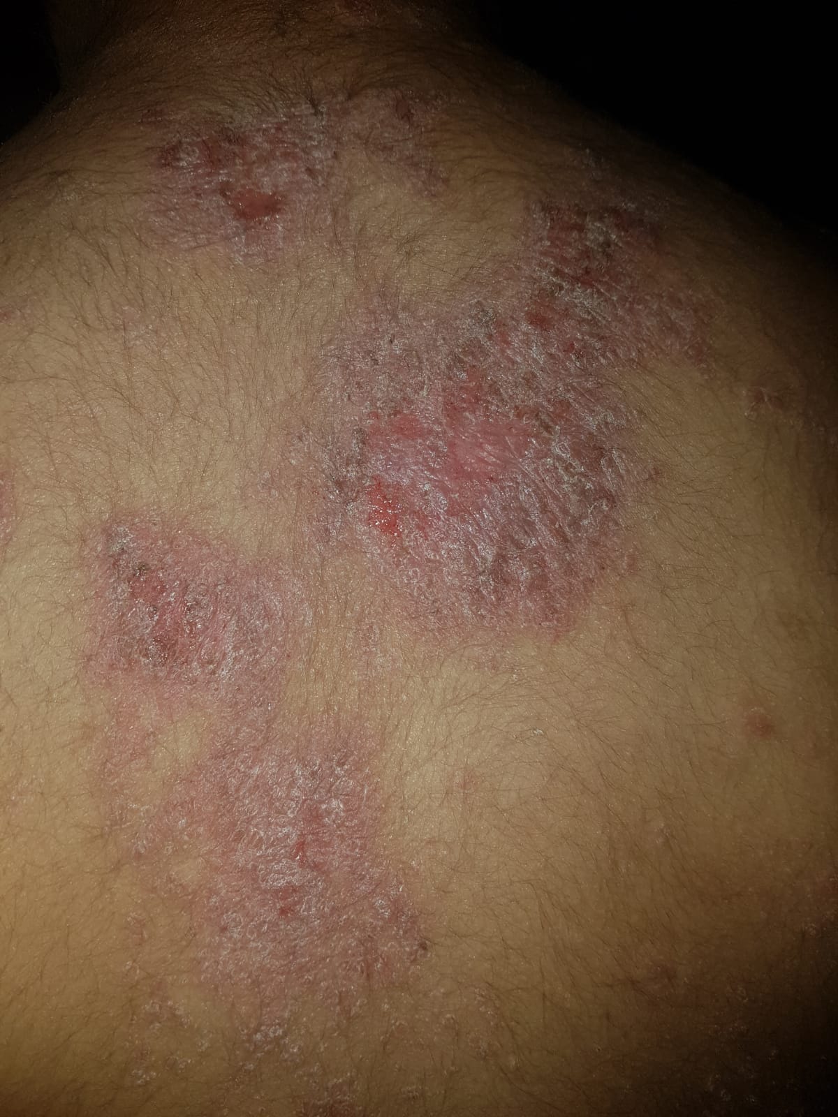 La Psoriasis Una Enfermedad Mas Alla De La Piel Diario Salud