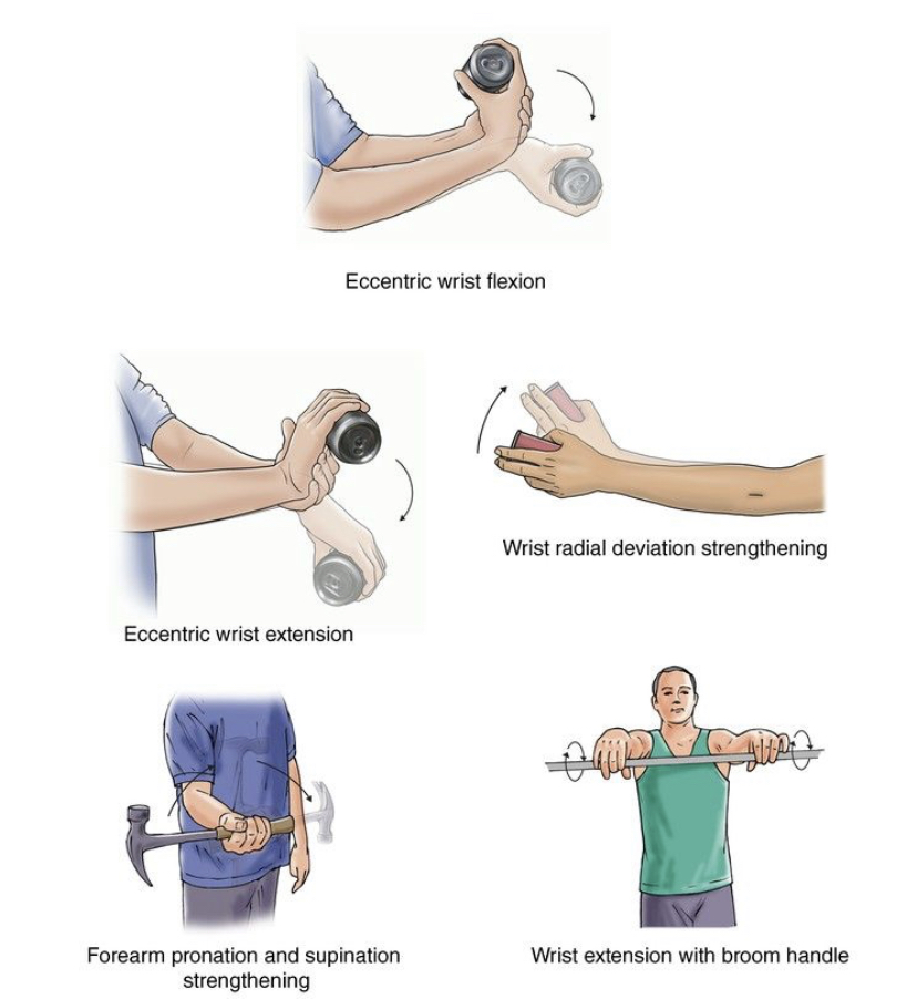 Tennis Elbow Surgical Treatment Dr Anastasia Orthopaedic Surgeon And Sports Medicine Consultant