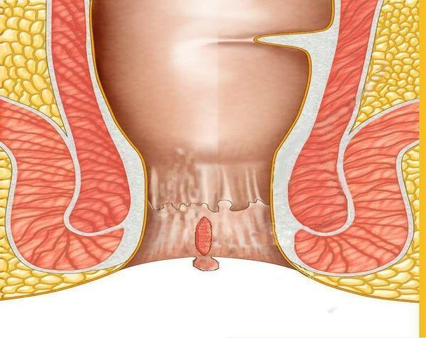 Ragade Anale Cause Sintomi Dieta Terapia E Intervento Chirurgico