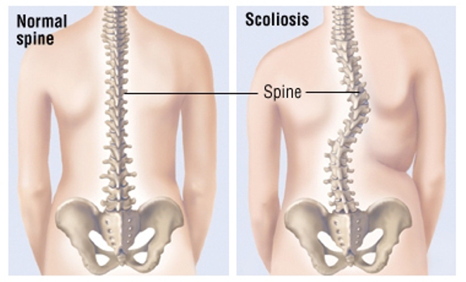 Scoliosis Treatment Eastside Medical Group