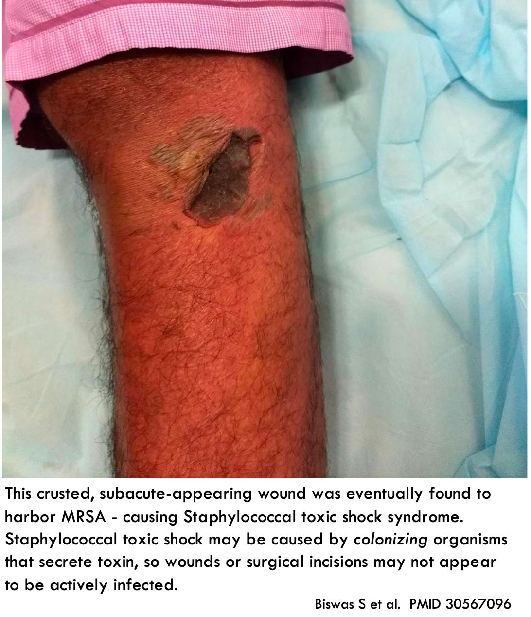 Toxic Shock Syndrome Tss Emcrit Project